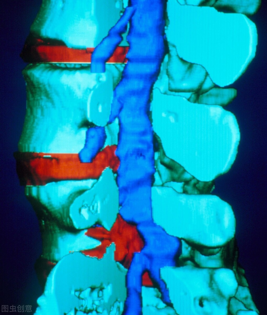 急性腰扭伤最快缓解方法,急性腰痛的处理思路