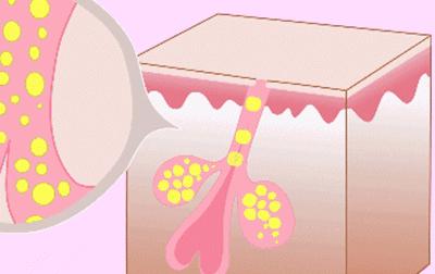 脸色发黄毛孔粗大出油严重怎么办,脸部爱出油长痘毛孔粗大怎么调理