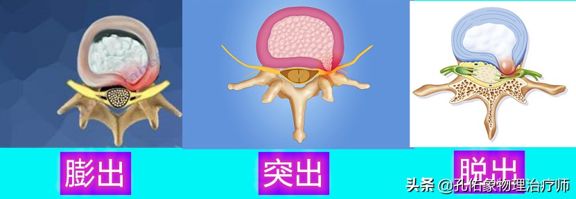 得了腰椎间盘突出怎么防止严重,腰椎间盘有病去哪治好