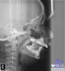 正畸医生如何指定方案的,正畸医生怎么说