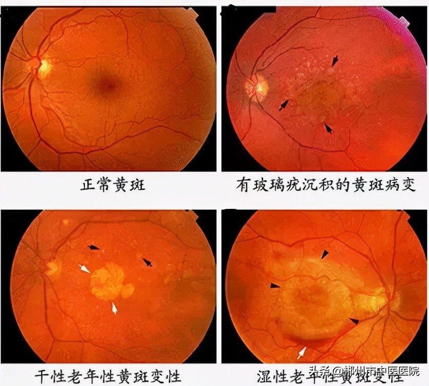 老年人视力障碍如何预防,老年人眼睛黄斑变性是什么意思
