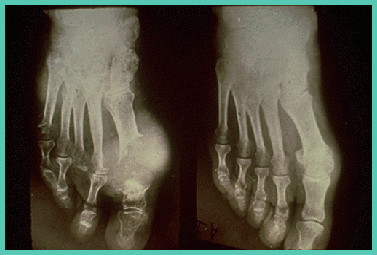 痛风石能挤碎吗,痛风石破溃后能自行愈合吗