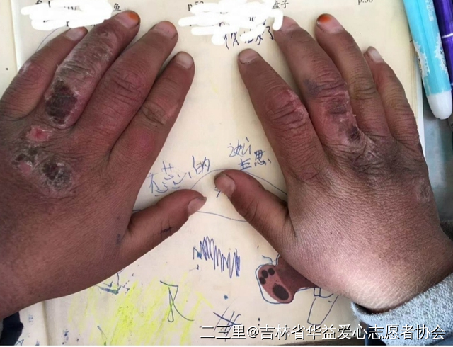 农村孩子手上都是冻疮,宝宝手上冻疮的治疗方法