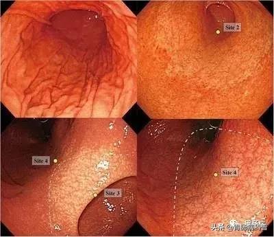 中医药治疗萎缩性胃炎，疗效卓著——你看一看这篇文章