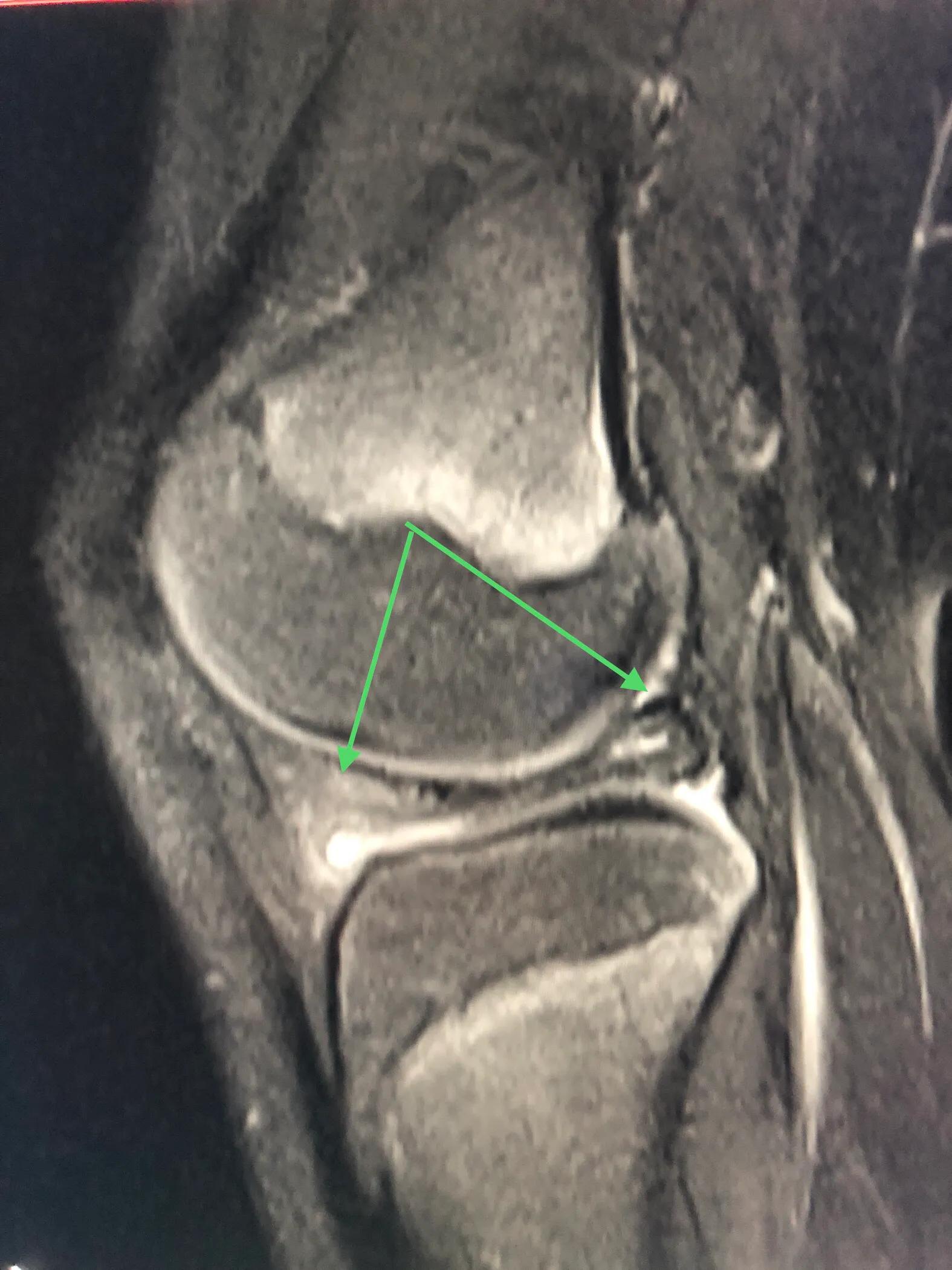 小构件大问题的膝关节半月板