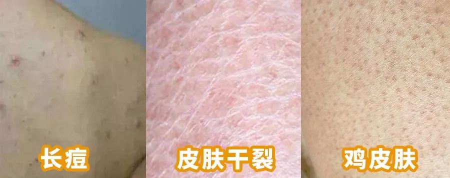 李佳琦推荐澳洲goat羊奶皂,李佳琦推荐黄黑皮克星