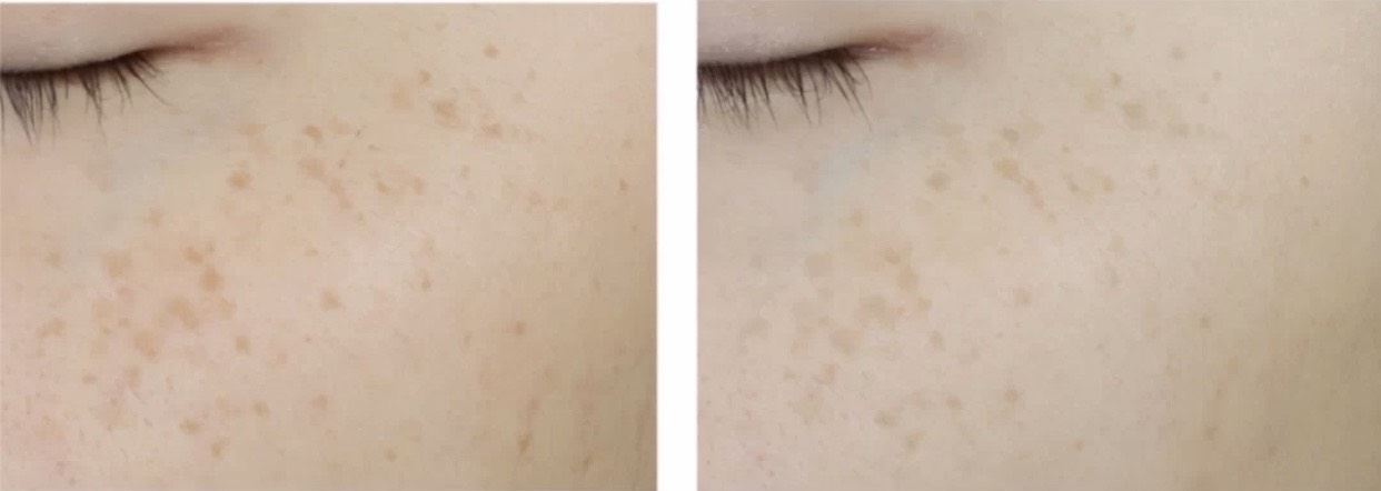 美白成分烟酰胺熊果苷会不会长毛,熊果苷成分的美白产品