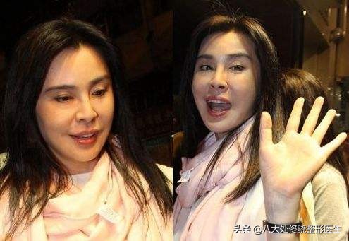 为什么注射玻尿酸会淤青,玻尿酸僵尸脸