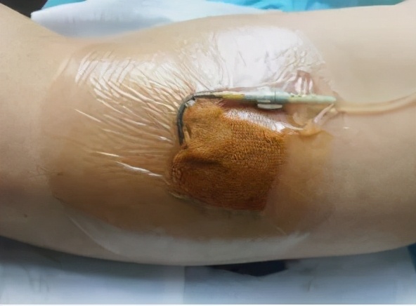 碘伏治疗伤口吗,碘伏治疗伤口发炎吗