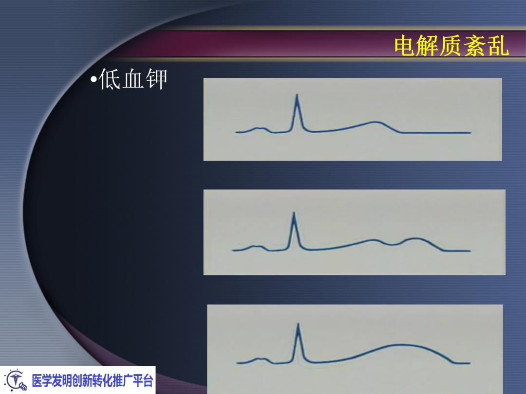 麻醉手术常见心律失常处理,麻醉引起心脏骤停原因