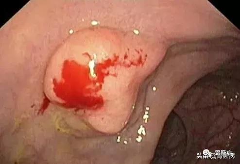 大肠息肉—藏在肚子里的定时*弹炸**，只要发现，必须格杀勿论！