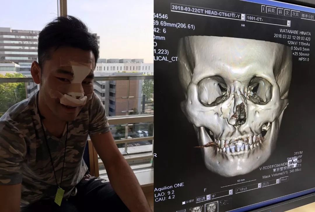 江通猜vs古拉宾,马拉特重拳ko江通猜