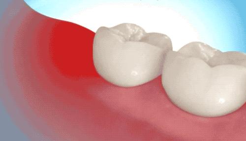 当智齿和蛀牙一块犯的时候,智齿牙髓炎直接拔还是开髓引流