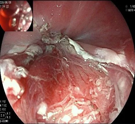贲门隆起性病变影像,贲门溃疡隆起性病变