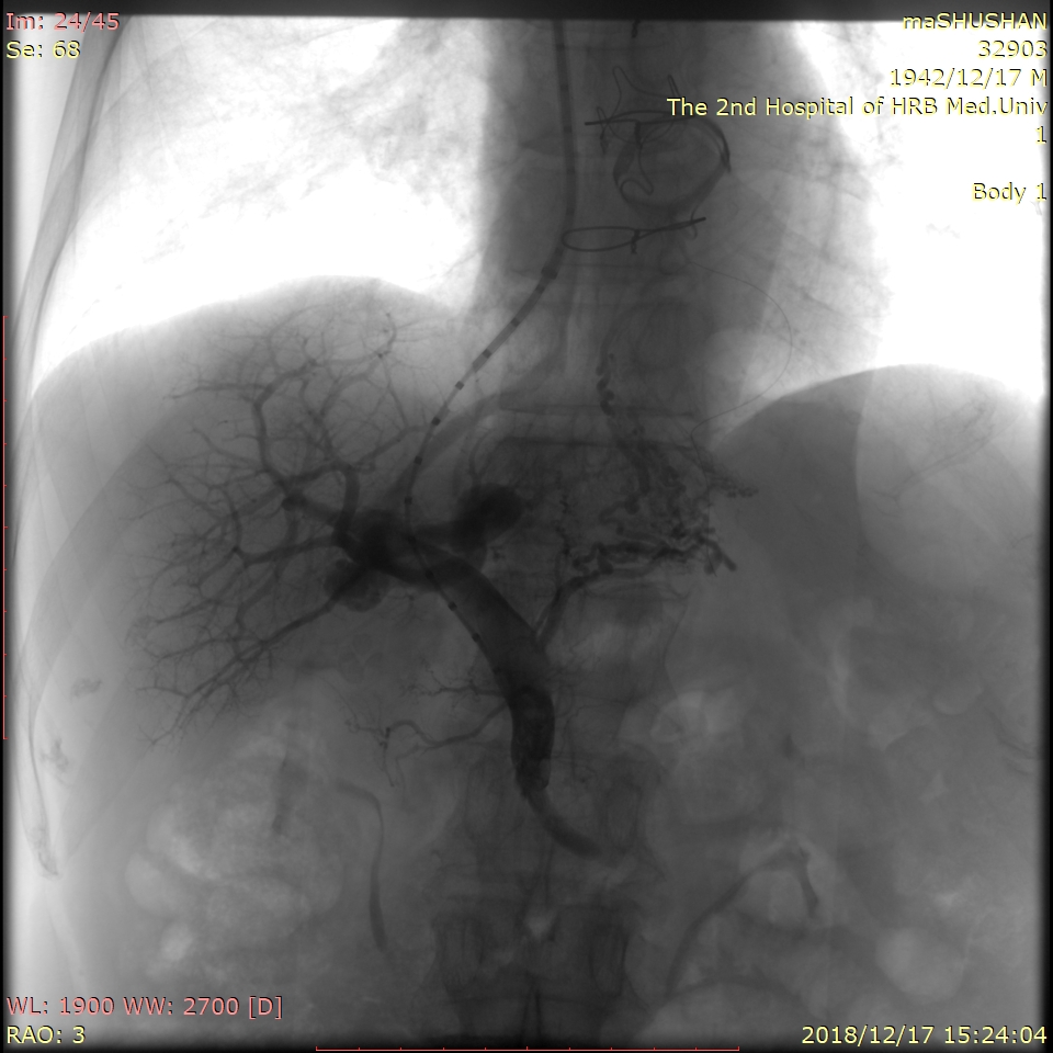 哈医大二院介入科专家,哈医大二院治肝权威教授