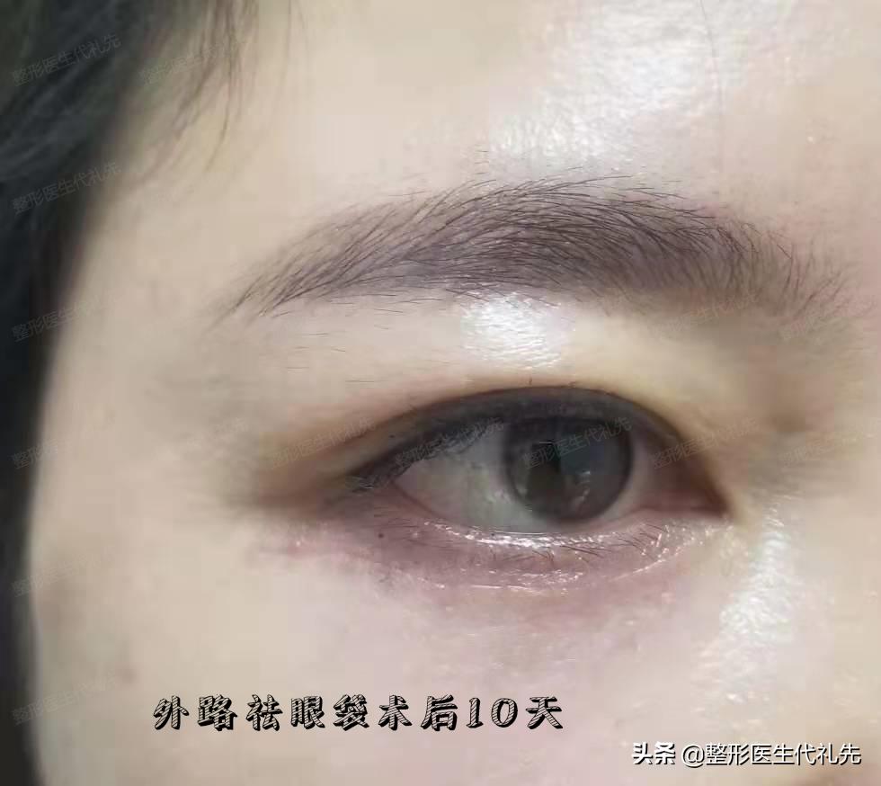 祛眼袋十问十答,提眉祛眼袋泪沟脂肪填充后