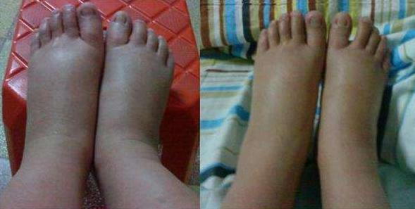 孕期的各种腿脚肿痛,哪些需要就医?