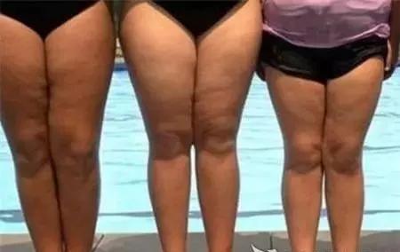 大腿前侧凸起一块肉怎么回事,大腿前侧突出什么样子