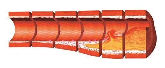 60岁动脉硬化怎么办,60岁血管硬化该怎么办