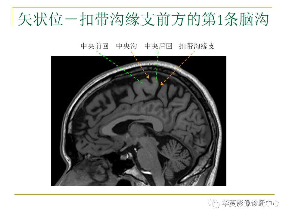 中国人脑立体定向mri应用解剖图谱,脑mri示意图