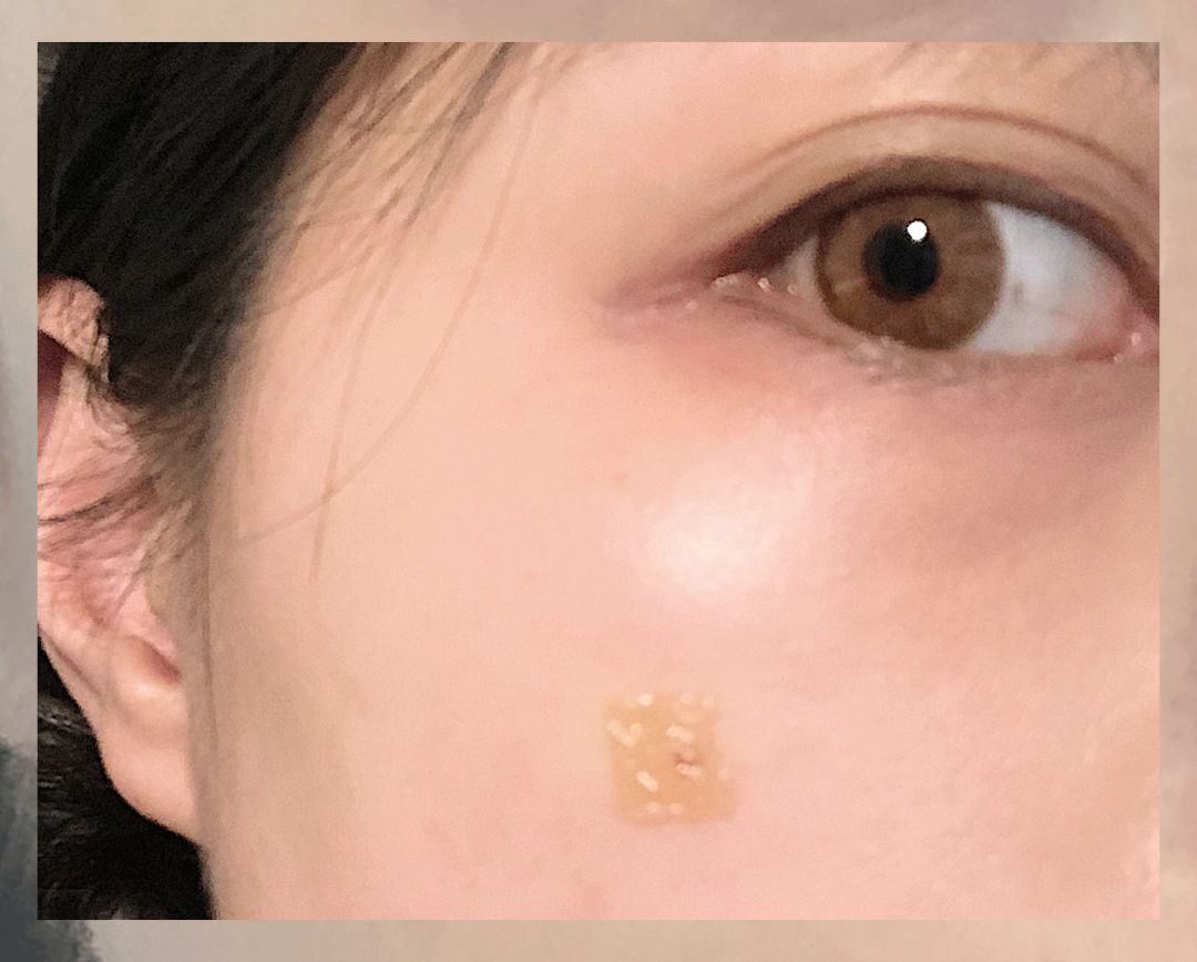 董氏奇穴一针治疗黑眼圈,熊猫针一针就能去掉黑眼圈吗