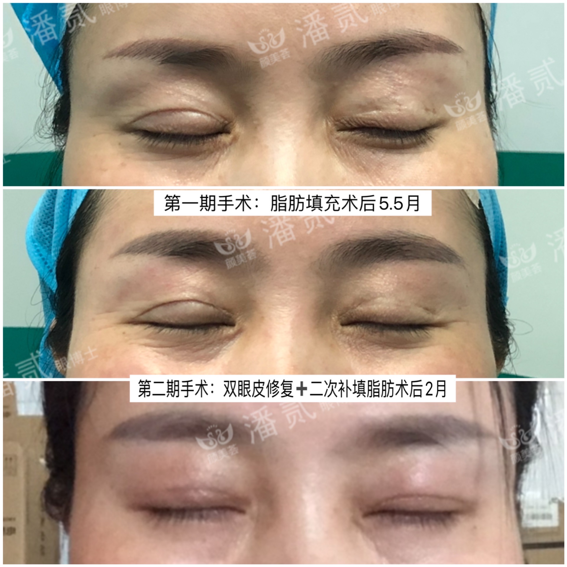 做双眼皮手术后眉毛会变吗,做双眼皮手术的疤痕会消失吗