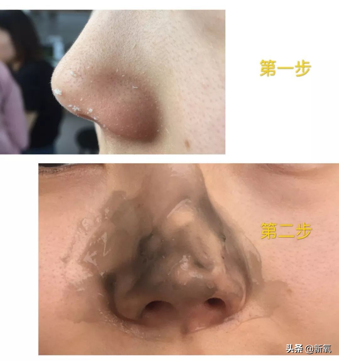 目前有真正去黑头的方法,最近超火的去黑头