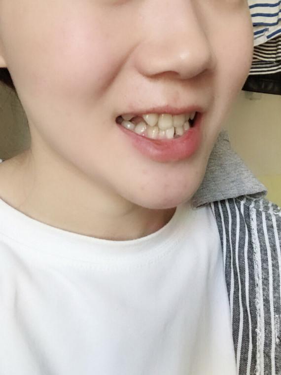 种植牙那么贵为啥不整治,一个牙医的良心忠告种植牙