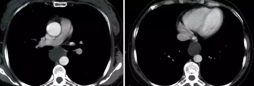 前上纵隔高密度影考虑胸腺未退化,肺纵隔胸腺结节12mm看什么科