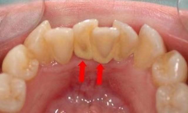 牙缝里黄黄的硬的,牙缝里臭臭的黄泥