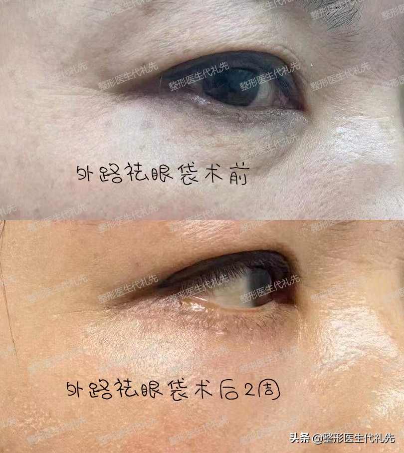 眼袋遗传的原因,眼袋大最简单手术去眼袋的方法