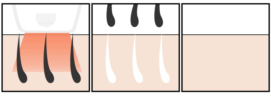 体毛脱毛的效果怎么样,天生体毛旺盛的人正常吗