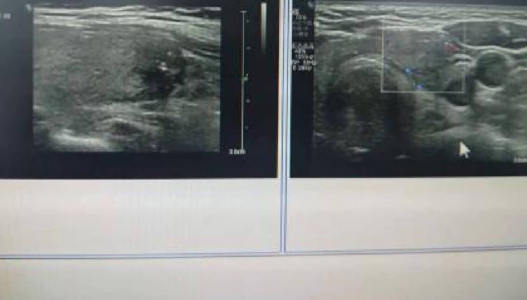 怎么消除脖子突然长起来的包块,脖子侧面鼓包是怎么回事视频