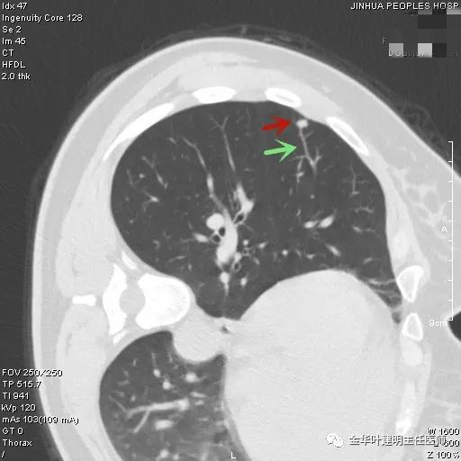 叶建明谈实性结节,叶建明肺实性良性结节会变癌症吗