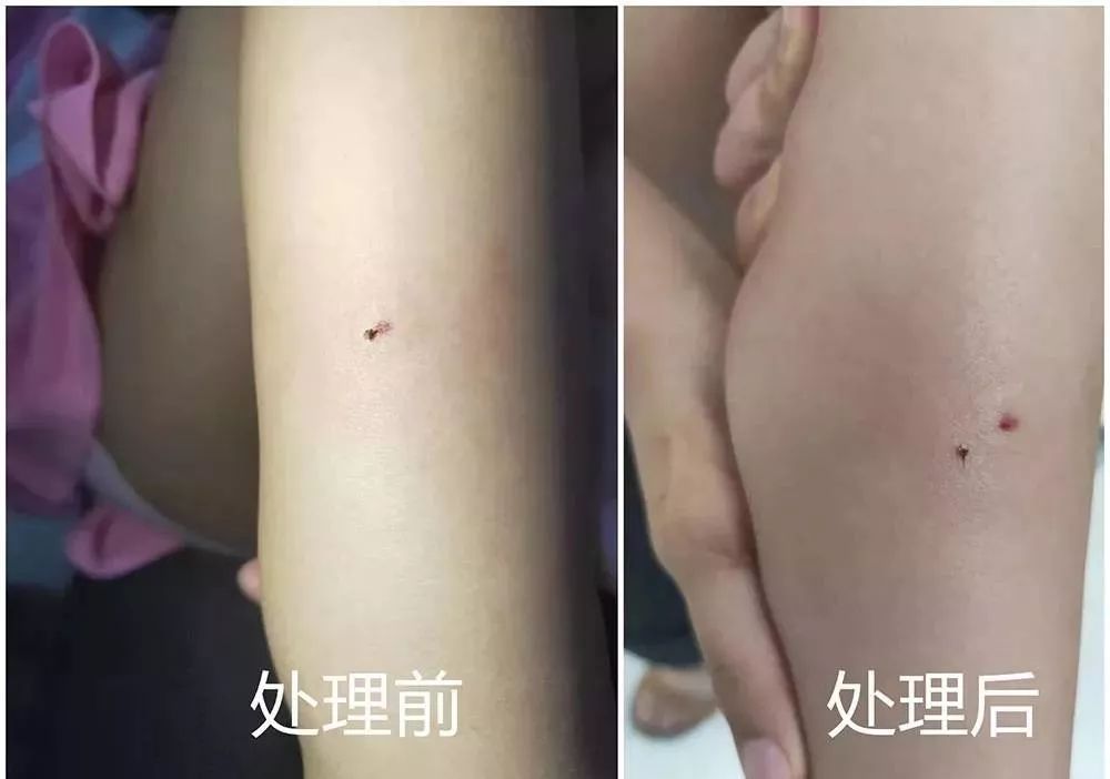 小孩被蜜蜂追着蜇伤,儿童被蜜蜂蛰了有没有刺怎么看