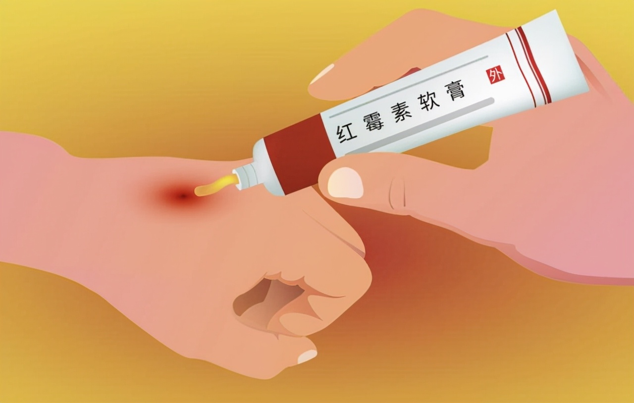 红霉素软膏作用与功效能治脚气吗,2块钱一支的红霉素