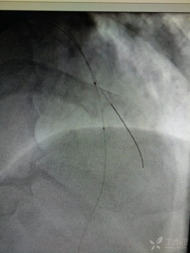 心电图心肌缺血冠脉造影正常,心脏彩超心电图冠脉造影正常