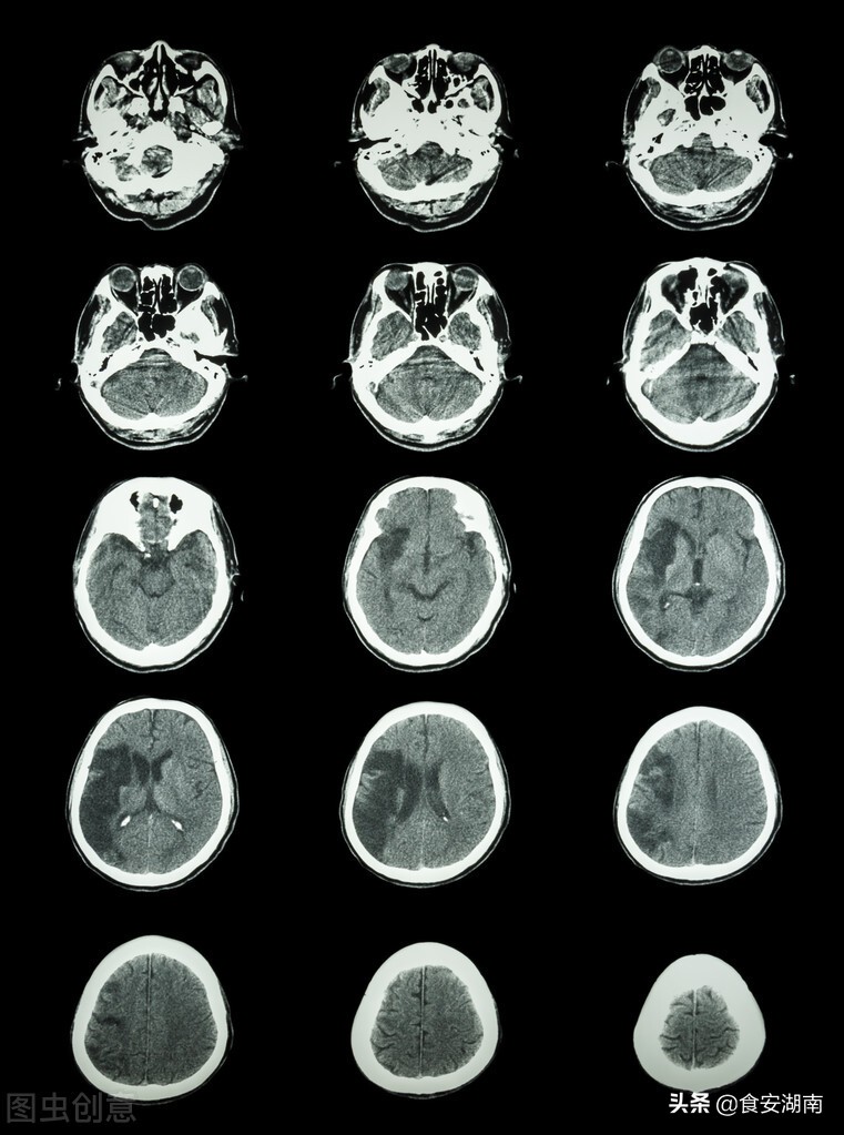 音乐疗法对脑卒中患者的影响,音乐对脑卒中干预的原理