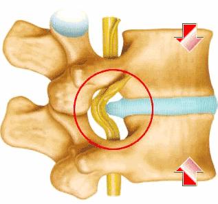 腰椎间盘突出腰不疼腿疼怎么回事,腰椎突出压迫神经腿疼睡觉姿势图