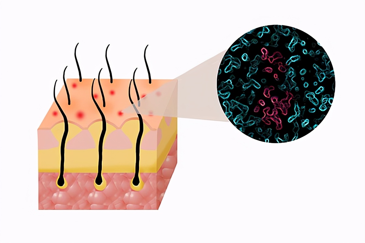 头皮痒，一挠指甲缝里就有白泥，这些白泥是什么？一文给你讲清楚