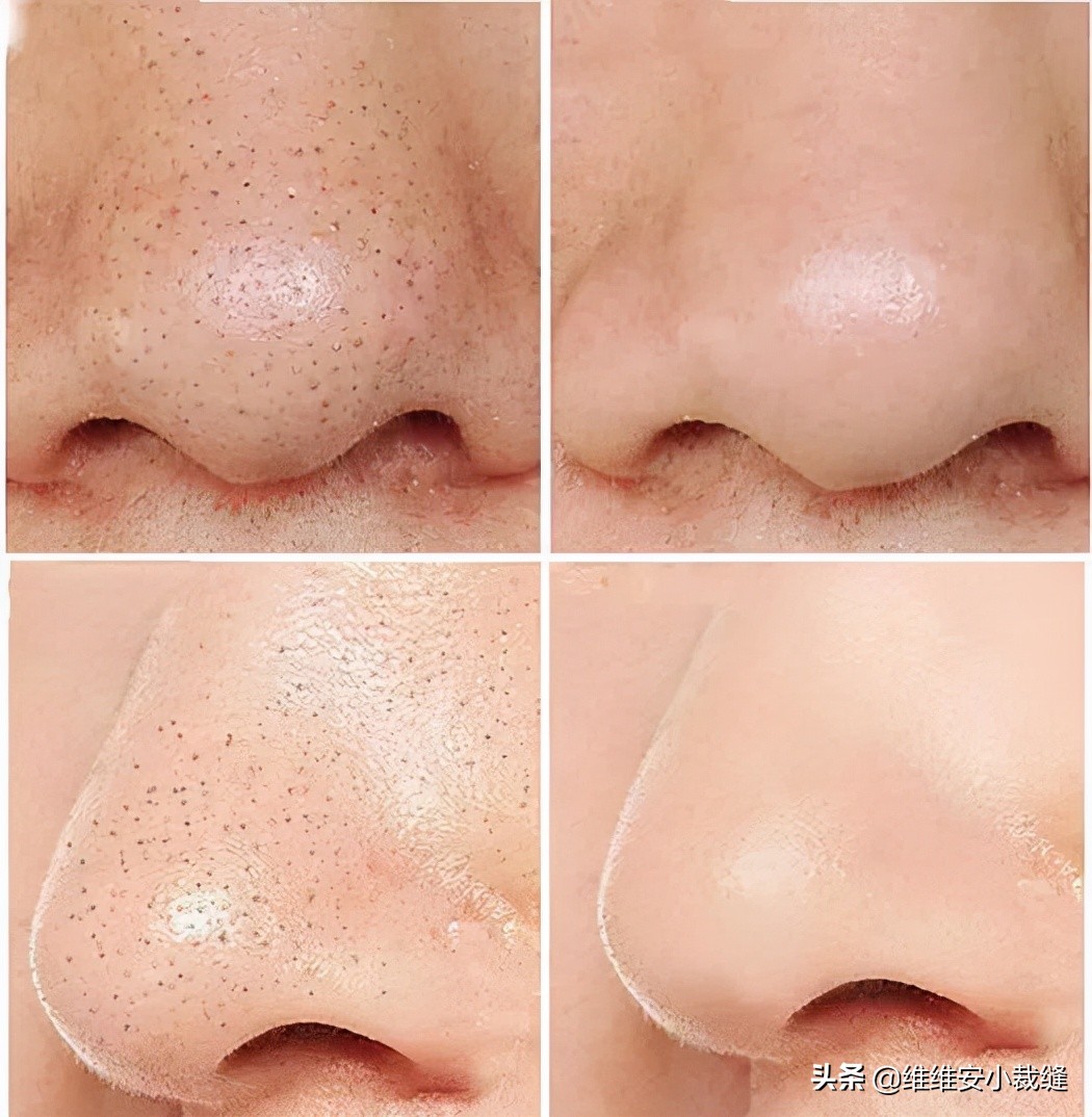 磨皮可以解决毛孔粗大,保留毛孔的质感磨皮教程