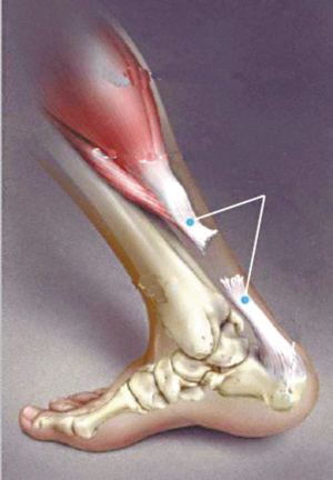 跟腱断裂杜兰特尼克斯,为什么考辛斯杜兰特都是跟腱断裂