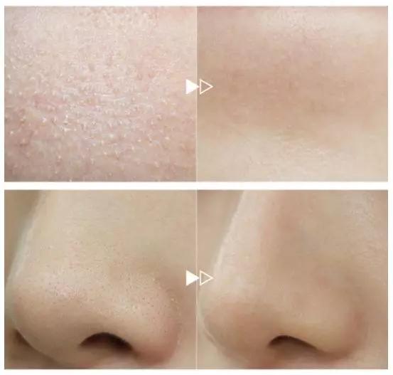 缓解抬头纹的最佳方法,抬头纹太严重了如何缓解去除