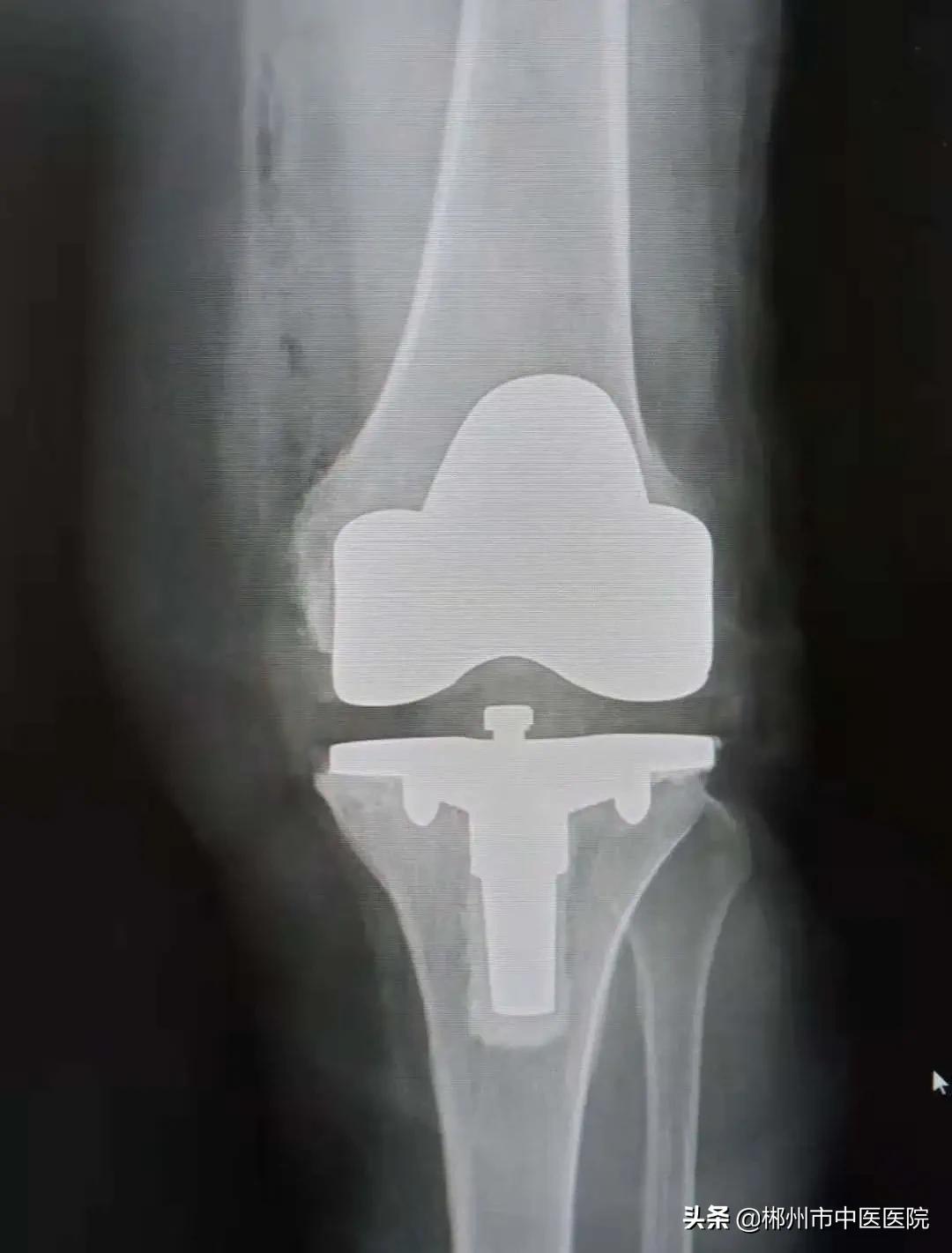 专家支招骨关节炎治疗,膝关节骨性关节炎疼痛怎么治疗