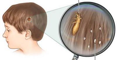 陕西渭南：一幼儿园女孩染头虱，奶奶用夹板烫死30多只