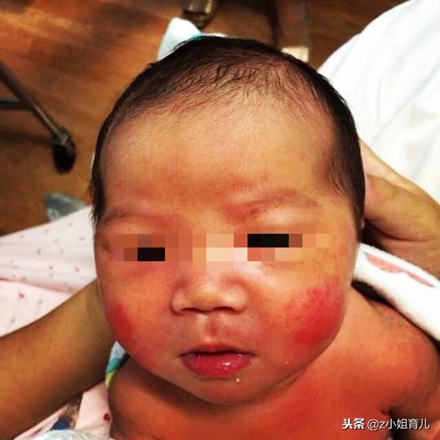 宝宝皮肤冻伤怎么办,宝宝冻疮破皮怎么尽快好