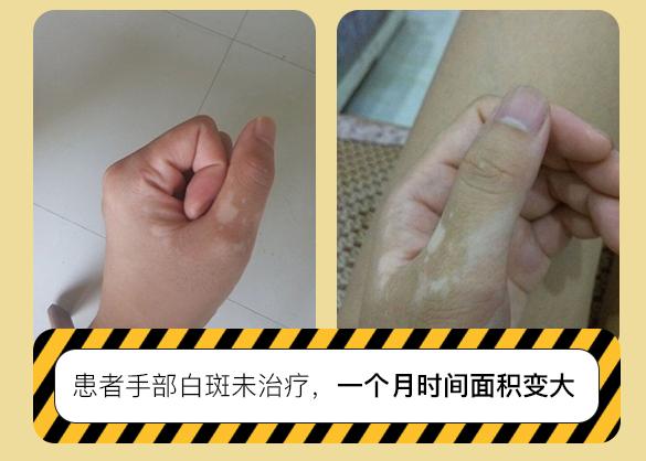 身上起小白点是什么原因怎么治,身上有一块白斑汗毛也是白的