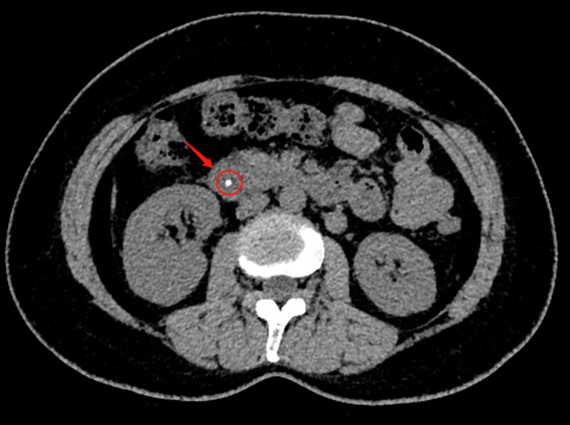女子体内取出活虫只因爱吃这样菜,深圳女子体内取出虫子