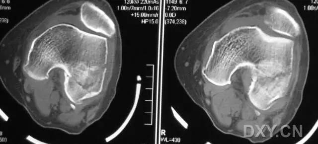 几种严重骨折医学名称,常见的骨折有哪些名称