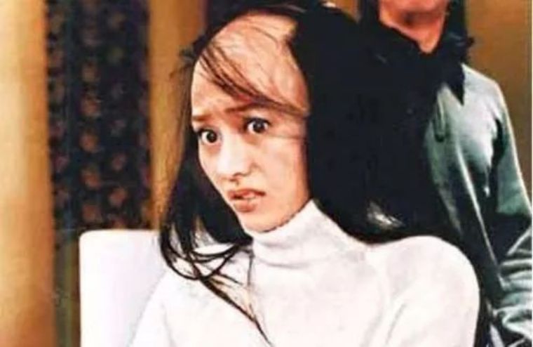 女人秃了一块怎么办,女性其实比男性秃